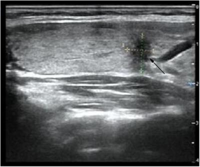 Diagnosis and treatment of HS after endoscopic thyroid surgery: case report and brief literature review